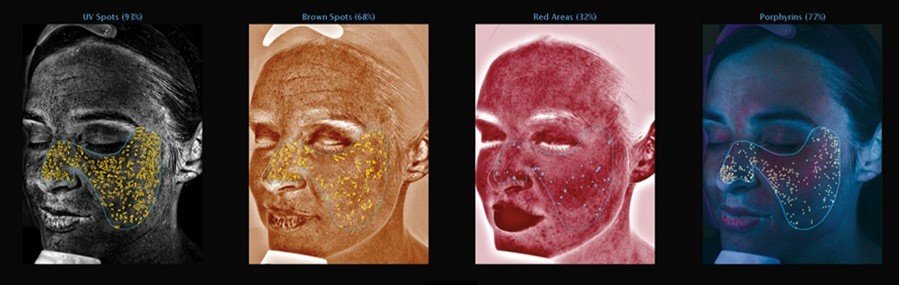 VISIA-Skin-Analysis-Main-Photo-3_right